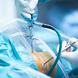 Arthroscopy in Guntur